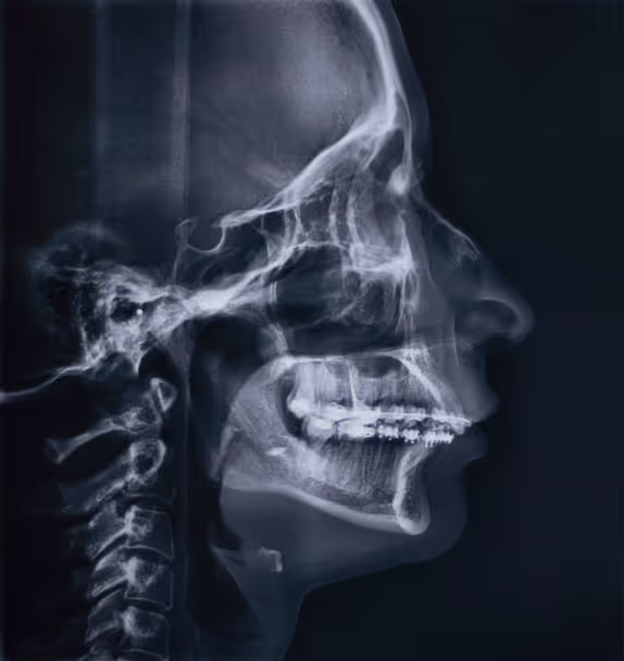 Lateral cephalometric X-ray showing skull, jaw, teeth, and cervical spine.