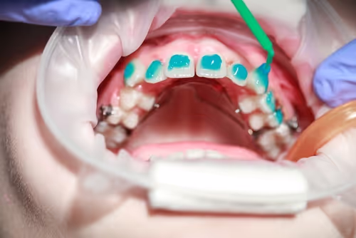 Close-up of dental procedure applying blue dental etching gel on upper front teeth.