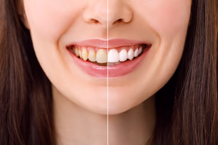 Close-up of a woman's smile showing before and after teeth whitening, with yellowed teeth on the left and bright white teeth on the right.