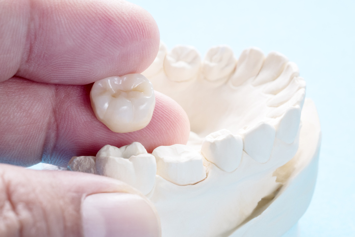Pediatric dental crown placement for a child at Coastal Kids Dentistry